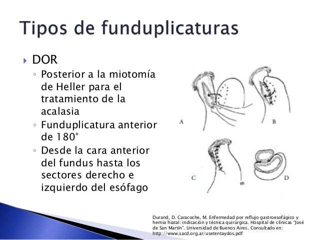 funduplicatura de dor